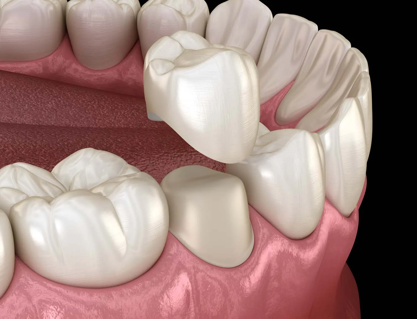 Ceramic dental crown at The Hills Dental Spa in Austin, TX