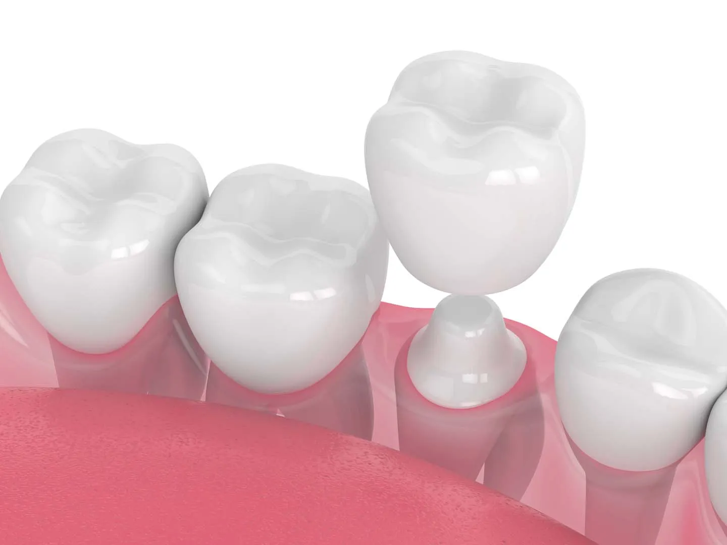 CEREC same-day ceramic crown at The Hills Dental Spa in Austin, TX