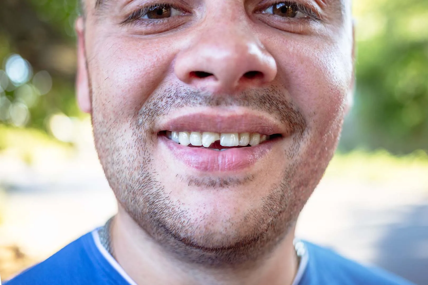 Chipped & Cracked Tooth Repair at The Hills Dental Spa in Austin, TX