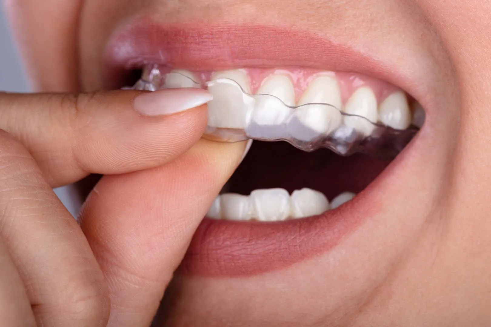 Clear aligner therapy at The Hills Dental Spa in Austin, TX