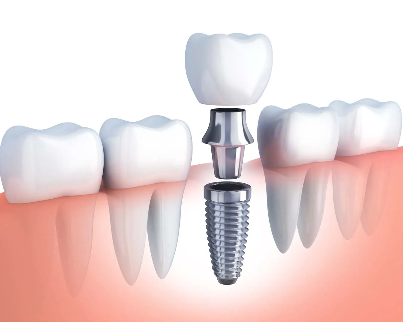 Computer-guided dental implant placement at The Hills Dental Spa in Austin, TX