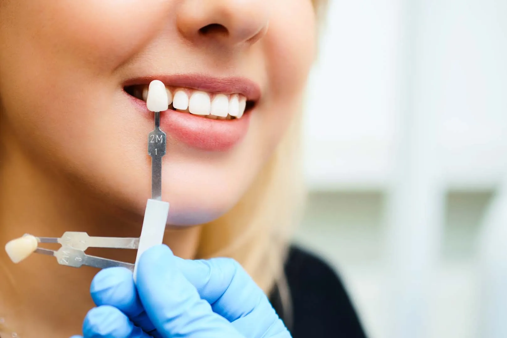 Shade matching for porcelain veneers at The Hills Dental Spa in Austin, TX
