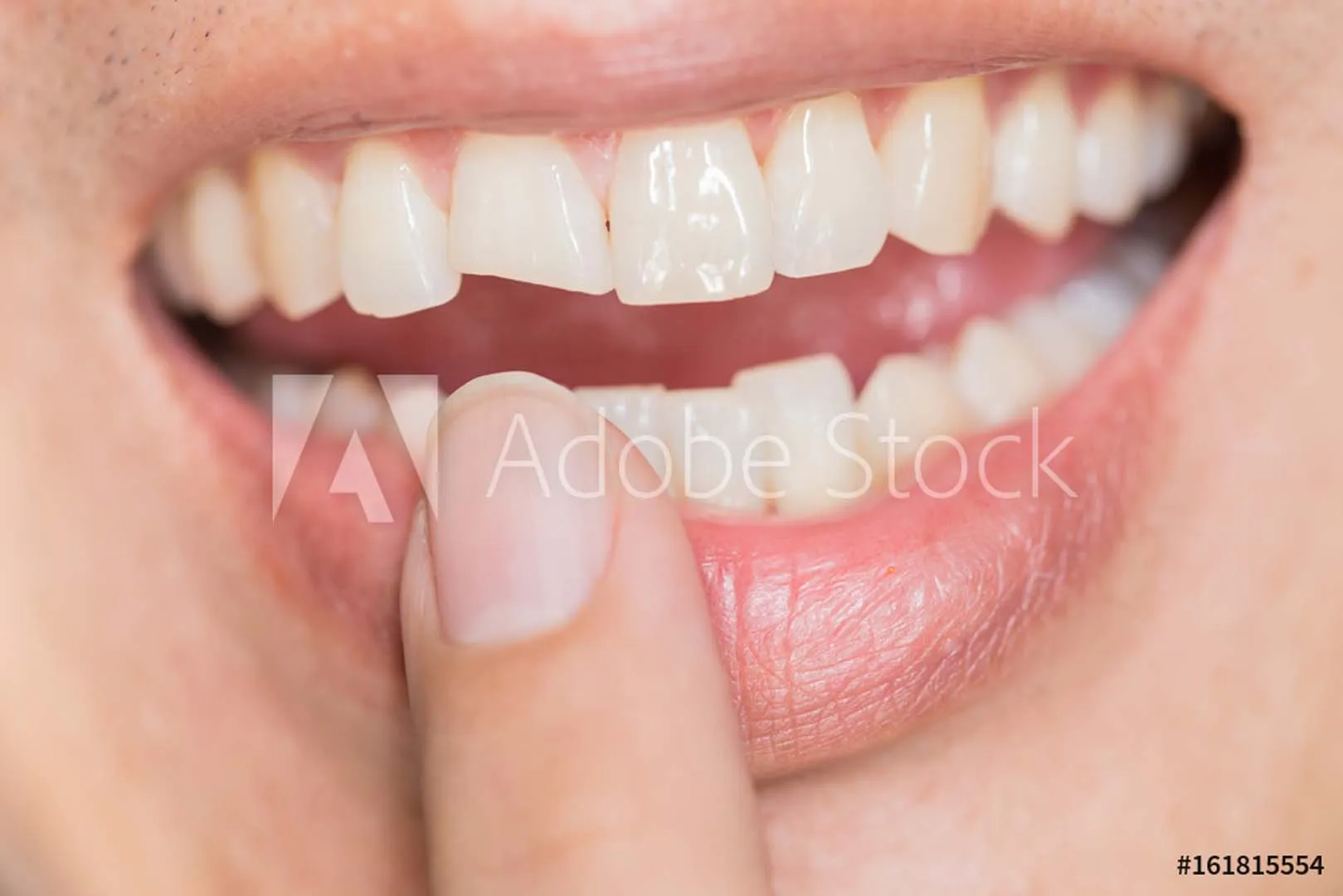 Chipped and cracked tooth repair at The Hills Dental Spa in Austin, TX