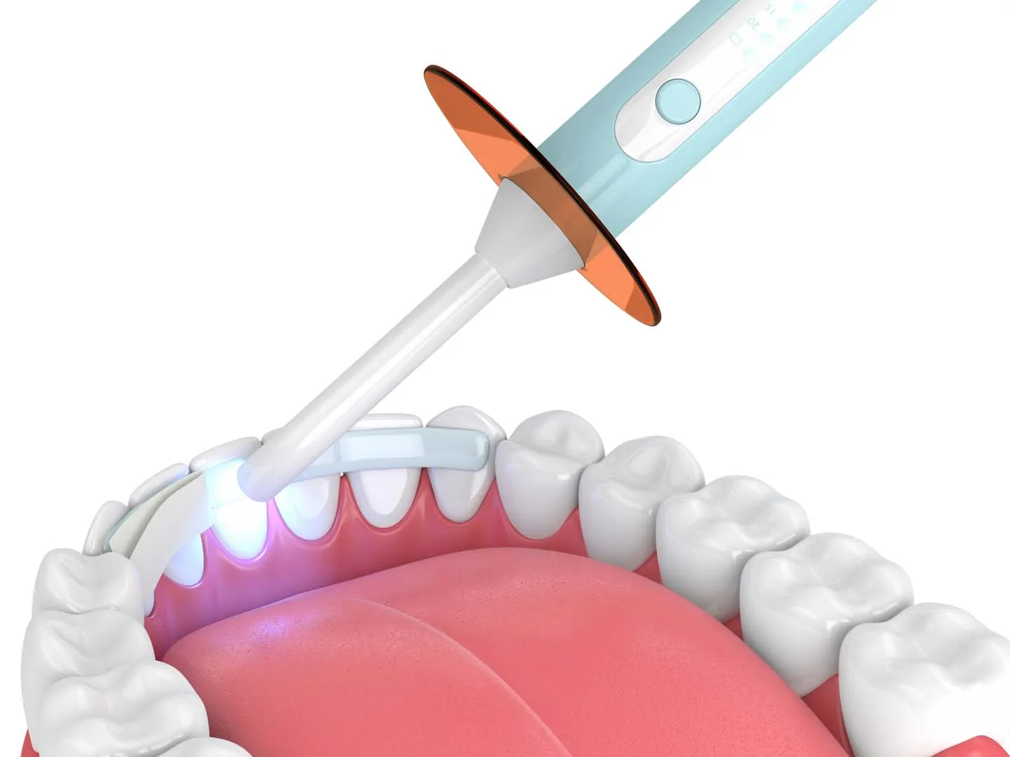Composite dental bonding at The Hills Dental Spa in Austin, TX