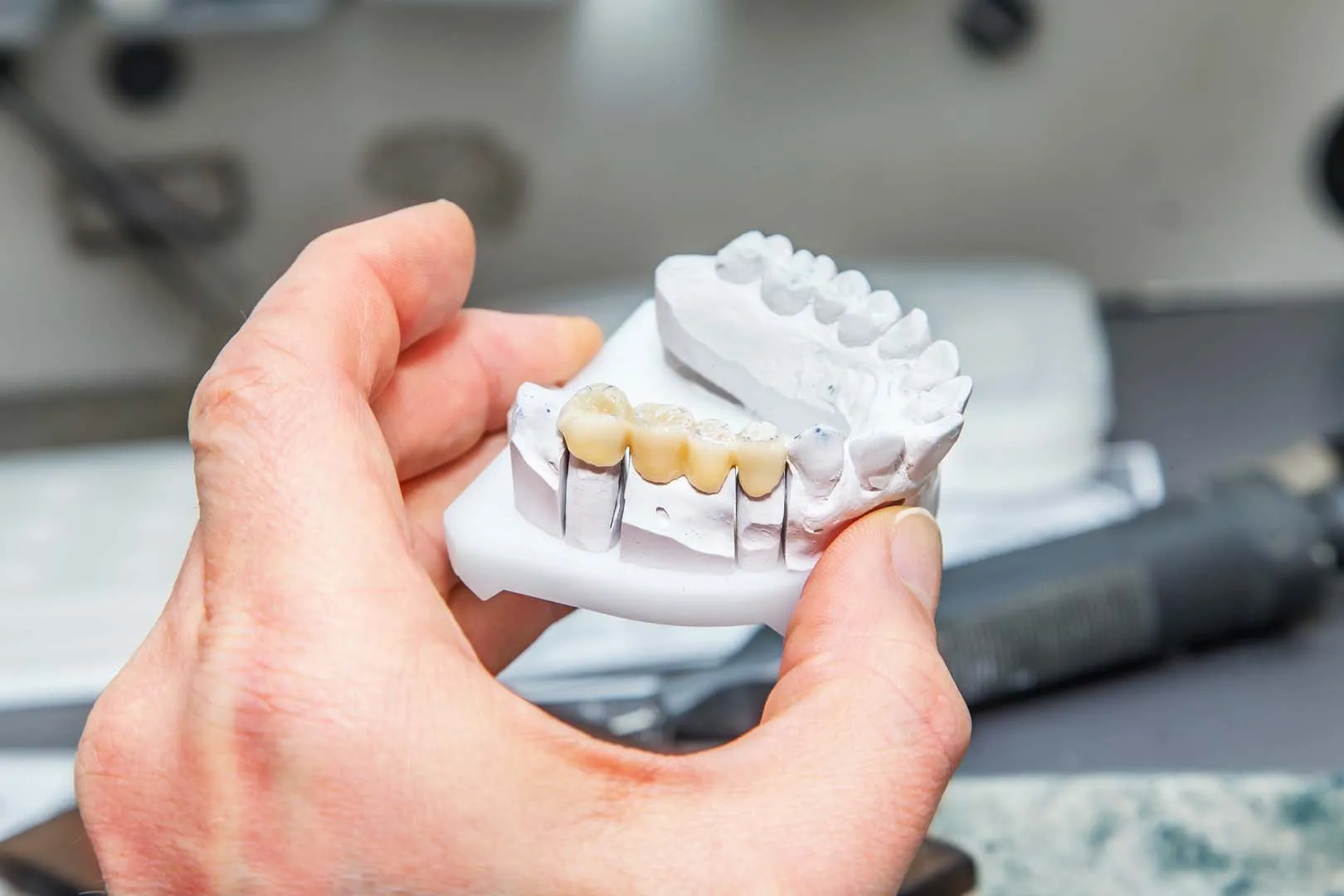 Dental Bridges at The Hills Dental Spa in Austin, TX