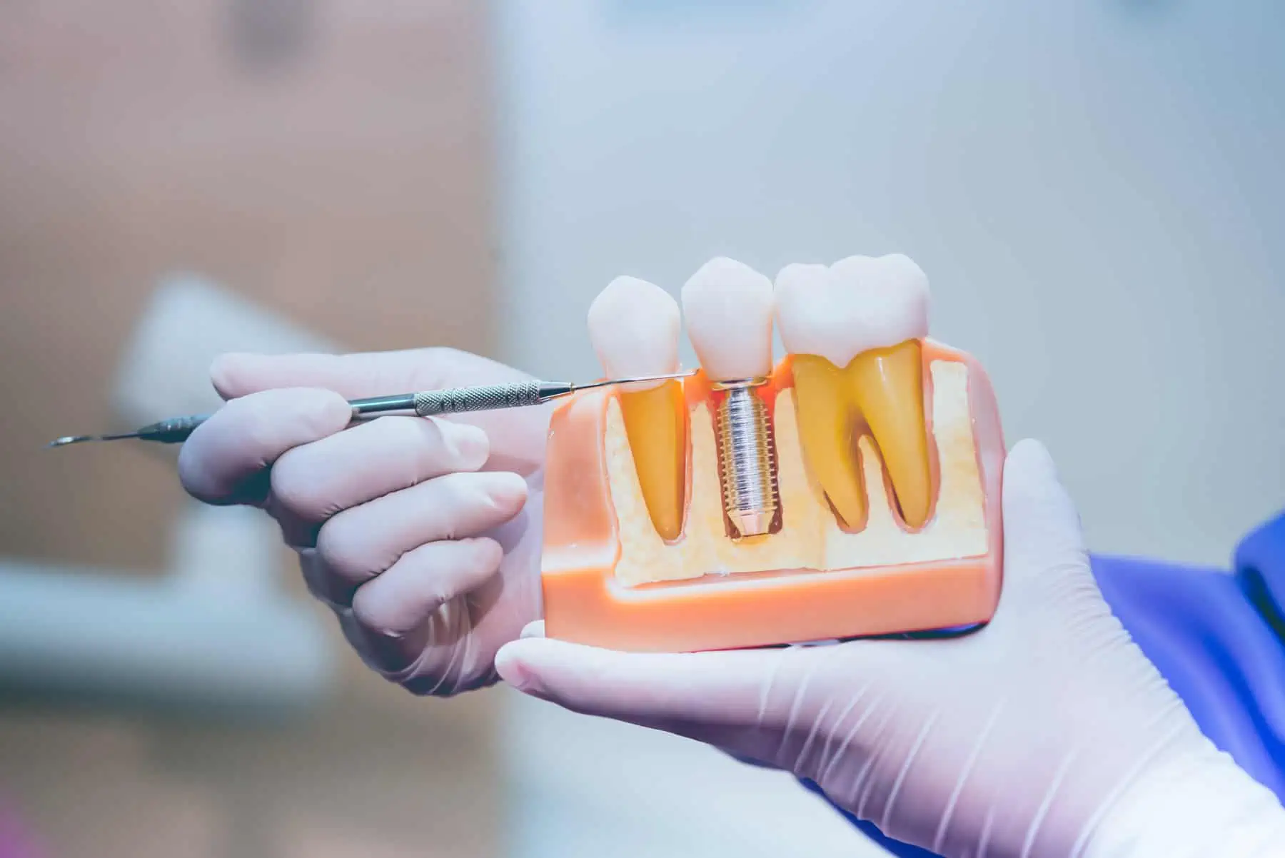 Dental Implants at The Hills Dental Spa in Austin, TX