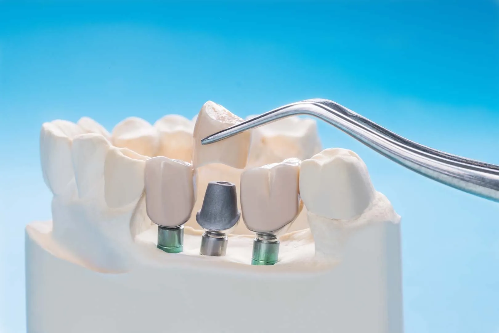 Implant-supported dentures at The Hills Dental Spa in Austin, TX
