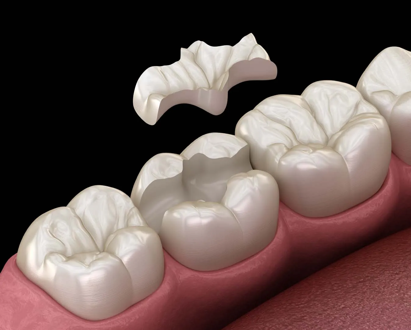Porcelain inlays and onlays at The Hills Dental Spa in Austin, TX