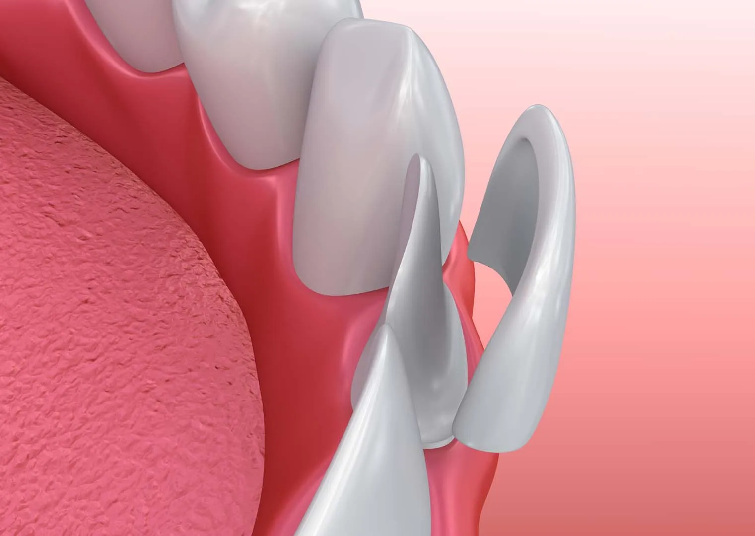 Porcelain veneers at The Hills Dental Spa in Austin, TX