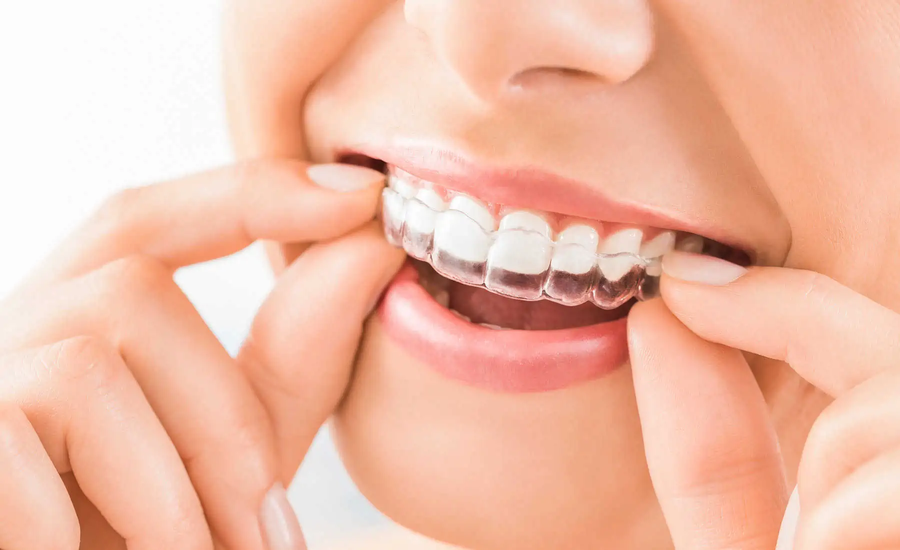 Invisalign at The Hills Dental Spa in Austin, TX