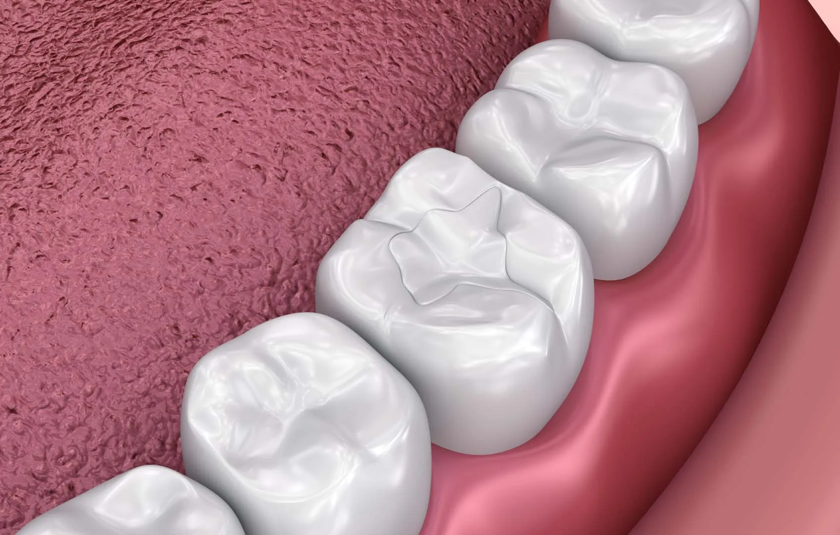 Tooth-coloured dental filling at The Hills Dental Spa in Austin, TX