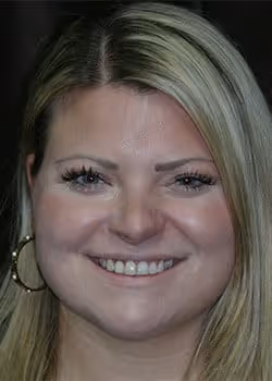 Aryca Before